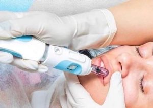 hyaluron pen fillers top beauty salon in sheffield